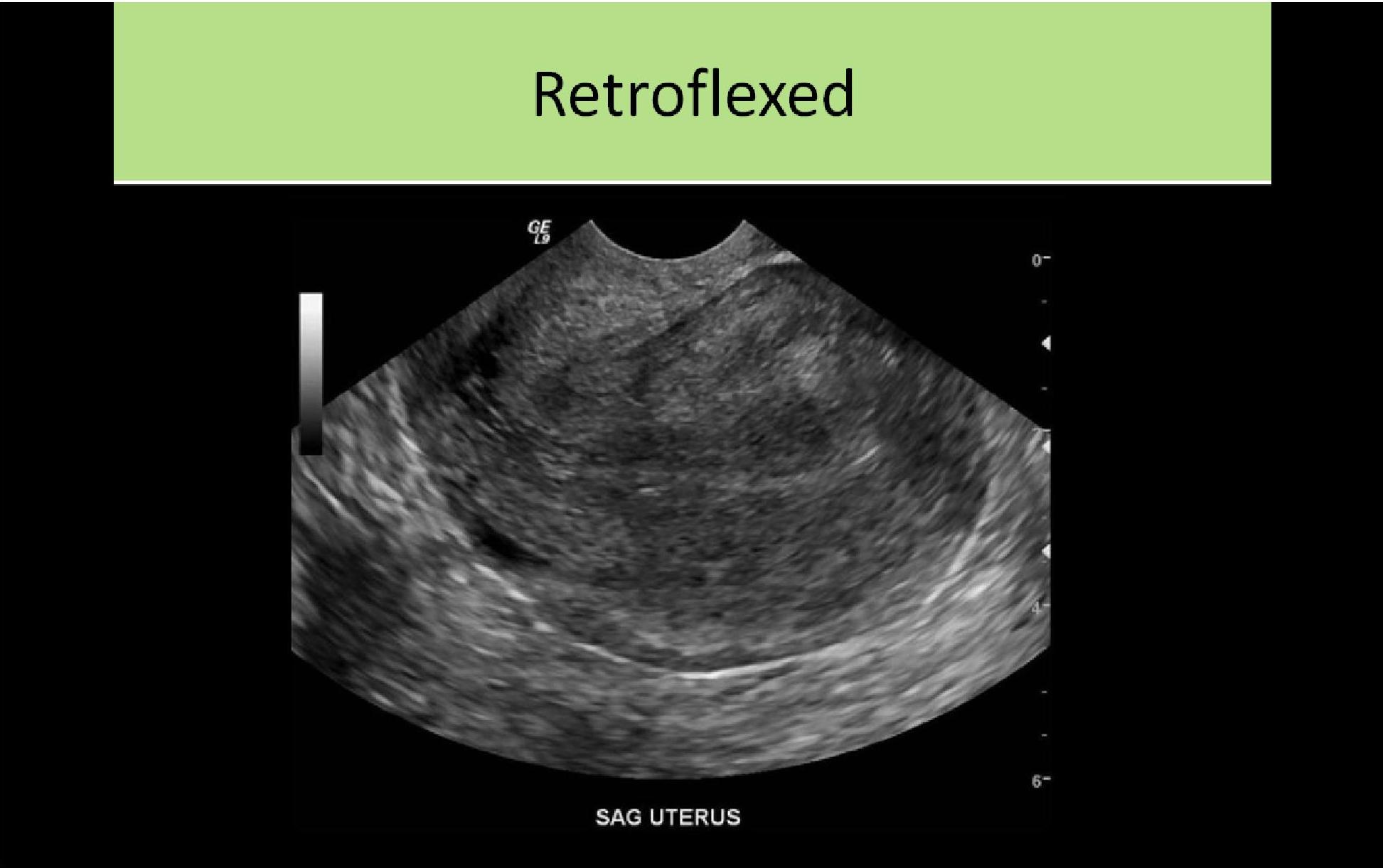 Retroflexed Uterus | Ultrasound, Sonography, Ultrasound sonography