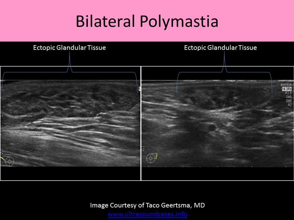 Bilateral polymastia