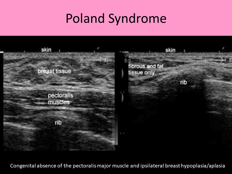 Poland Syndrome