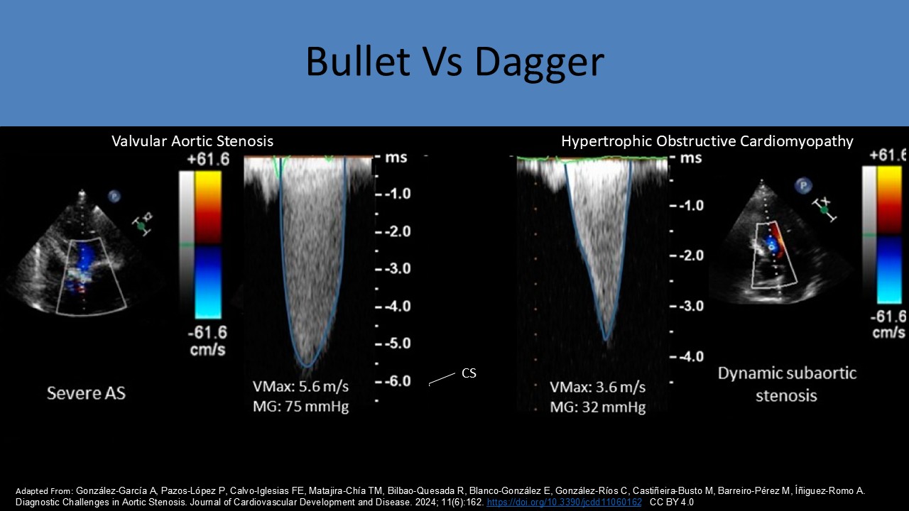 bullet vs dagger shaped waveforms