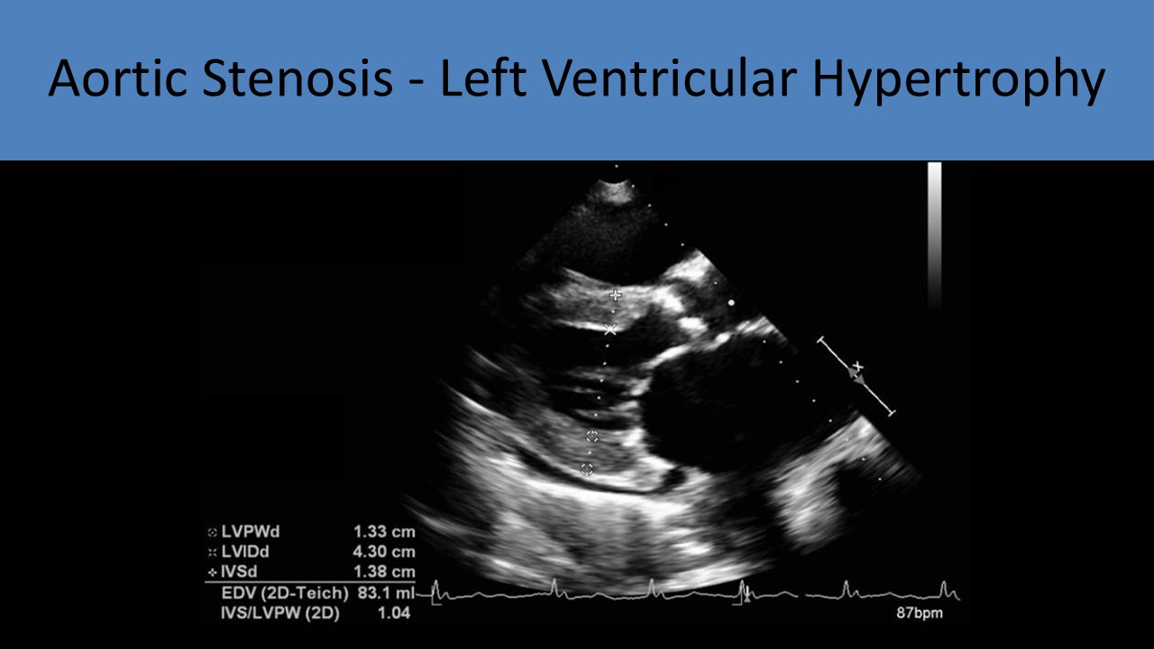 Severe Aortic Stenosis - LVH