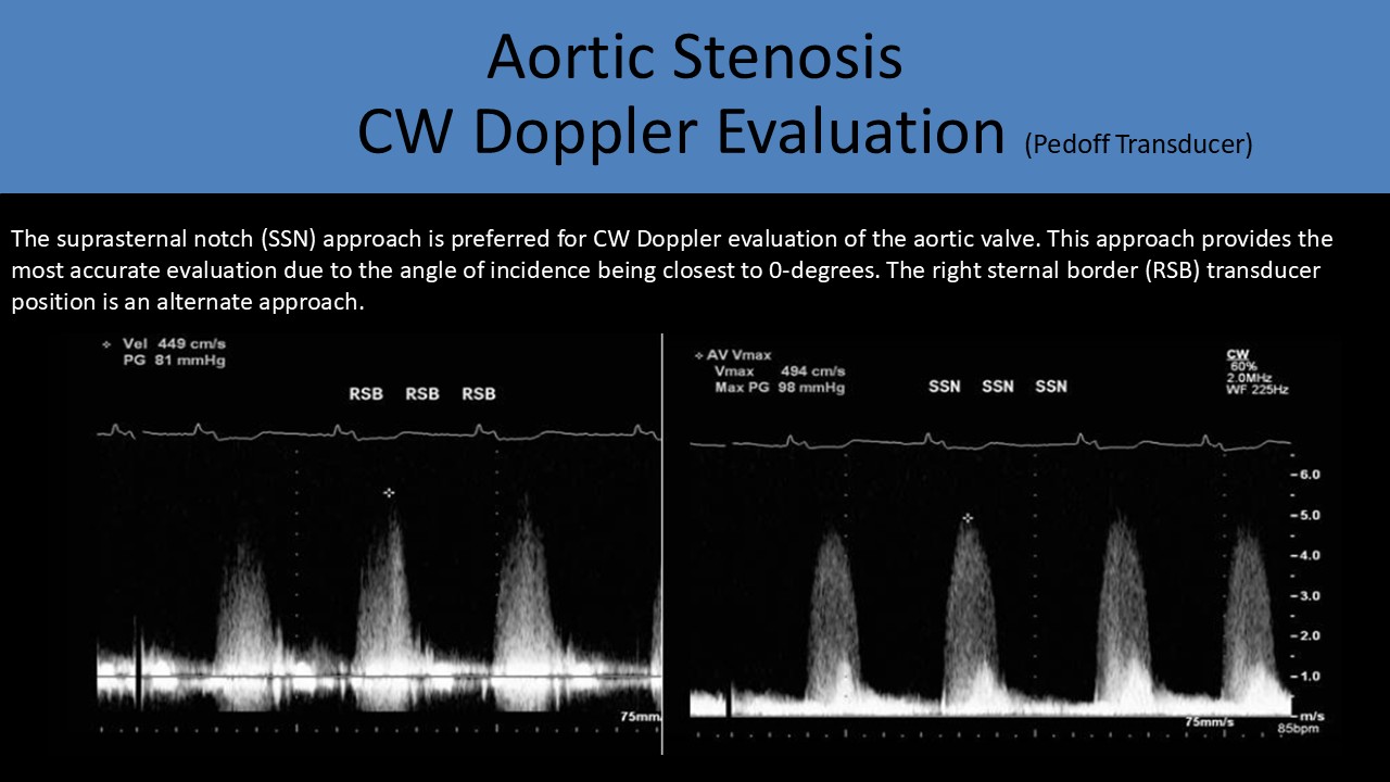 Aortic stenosis CW doppler