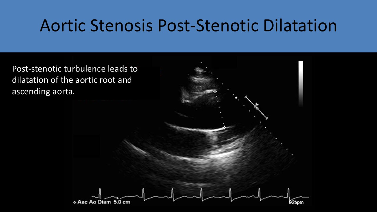 Post-stenotic dilatation