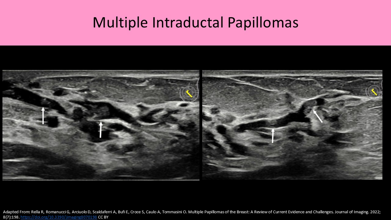 Breast ultrasound image 3
