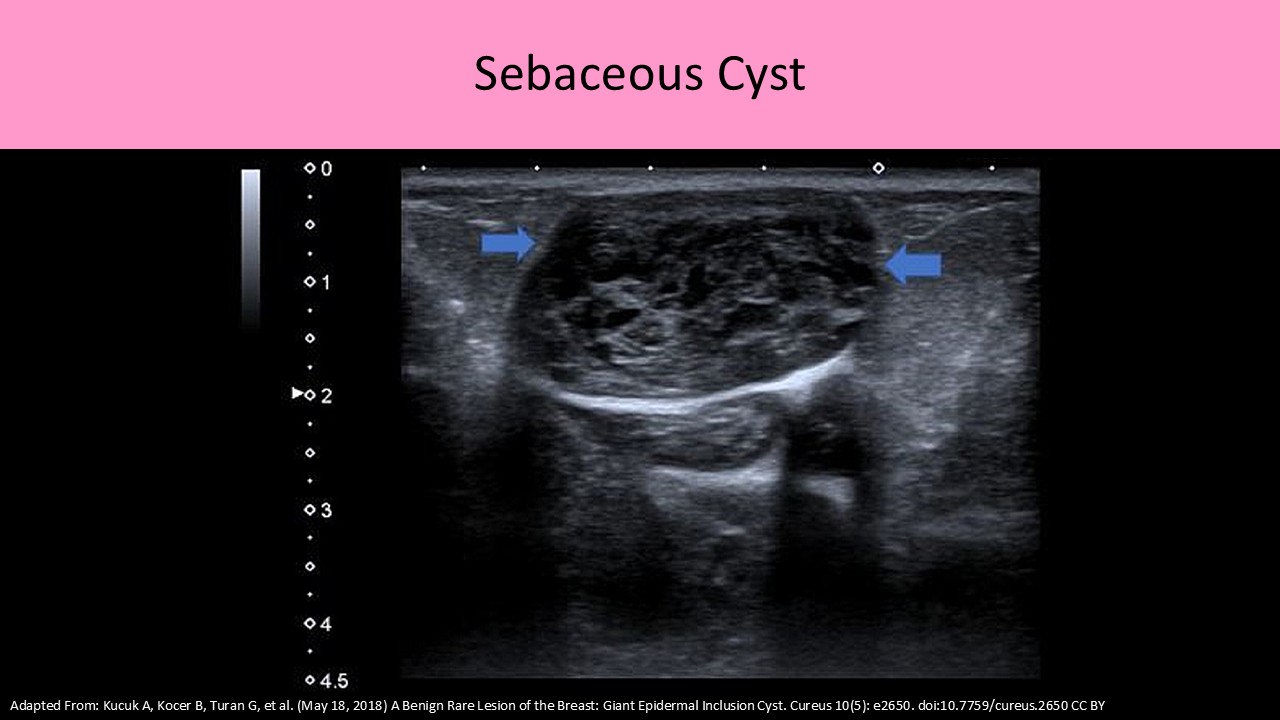 Breast ultrasound image 4