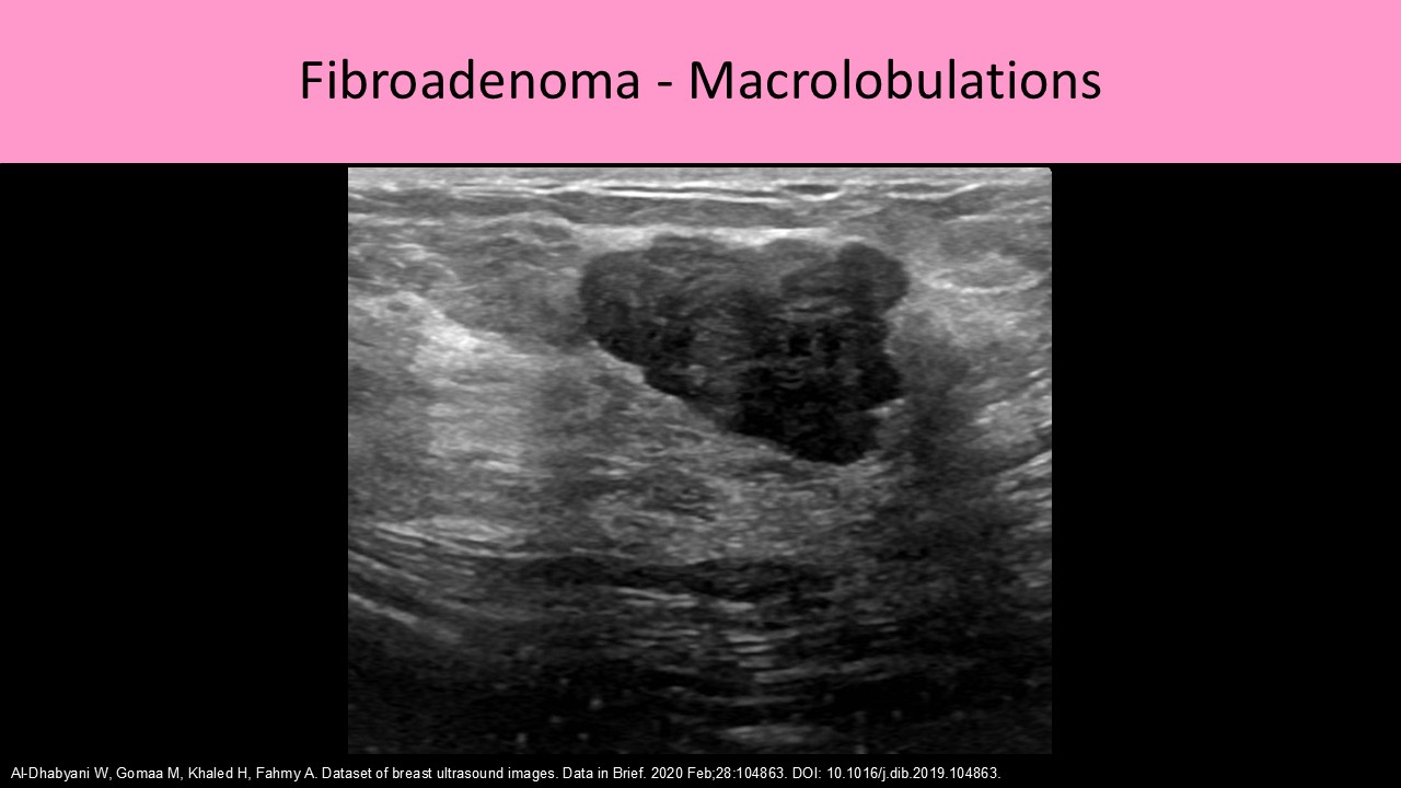 Breast ultrasound image 2