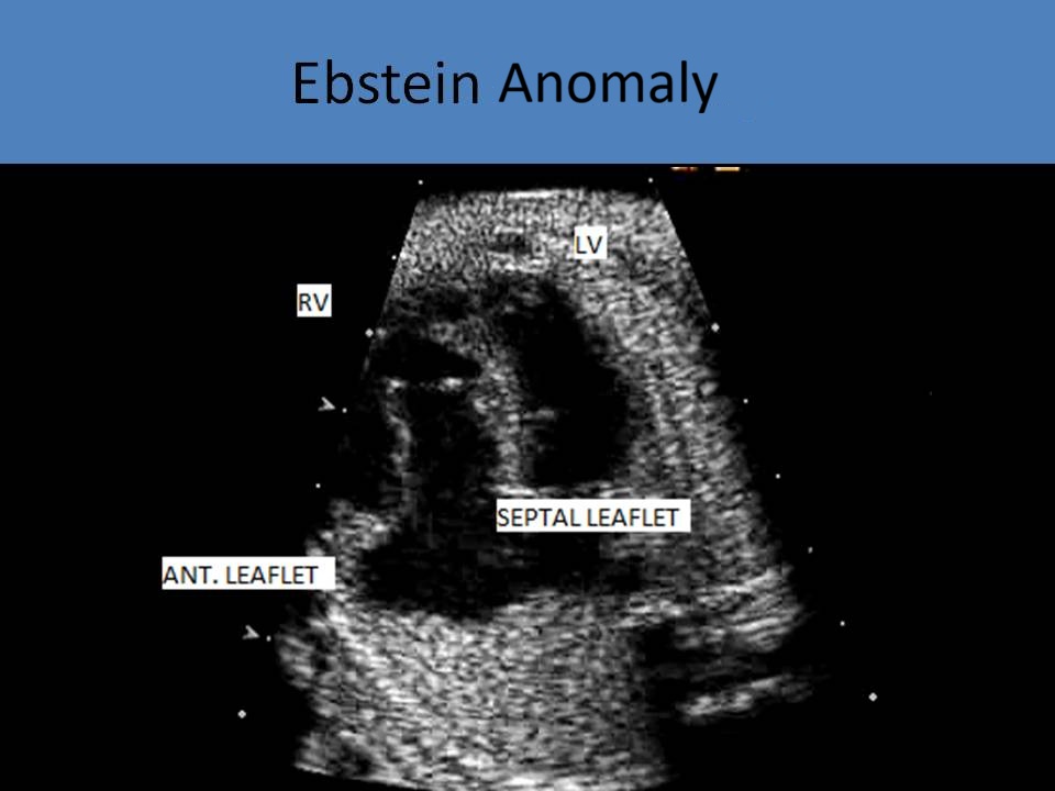 Ebstein Anomaly labeled
