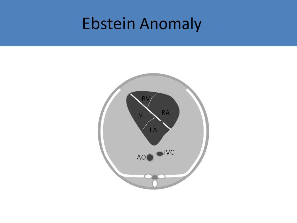 Ebstein Anomaly