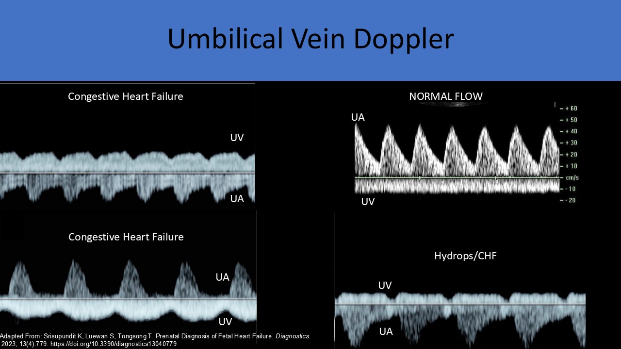Fetal echocardiography image 3