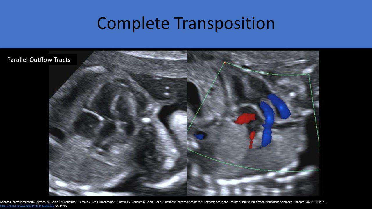 Fetal echocardiography image 4