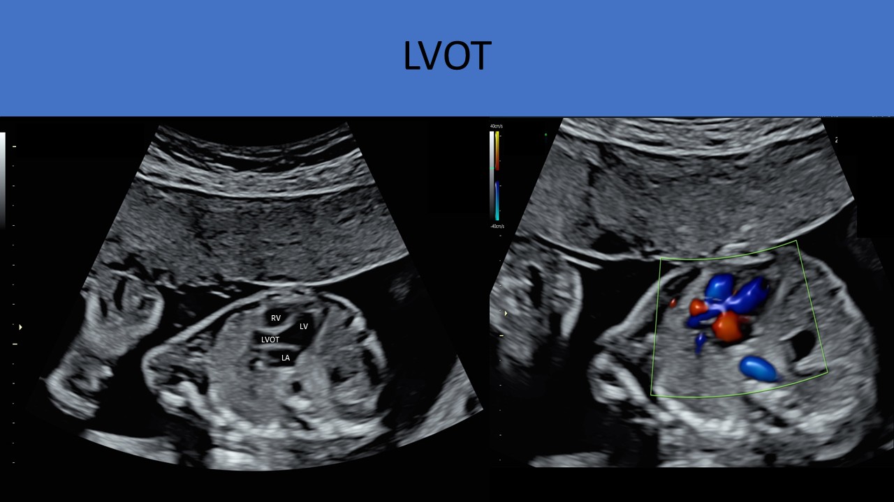 Fetal echocardiography image 5