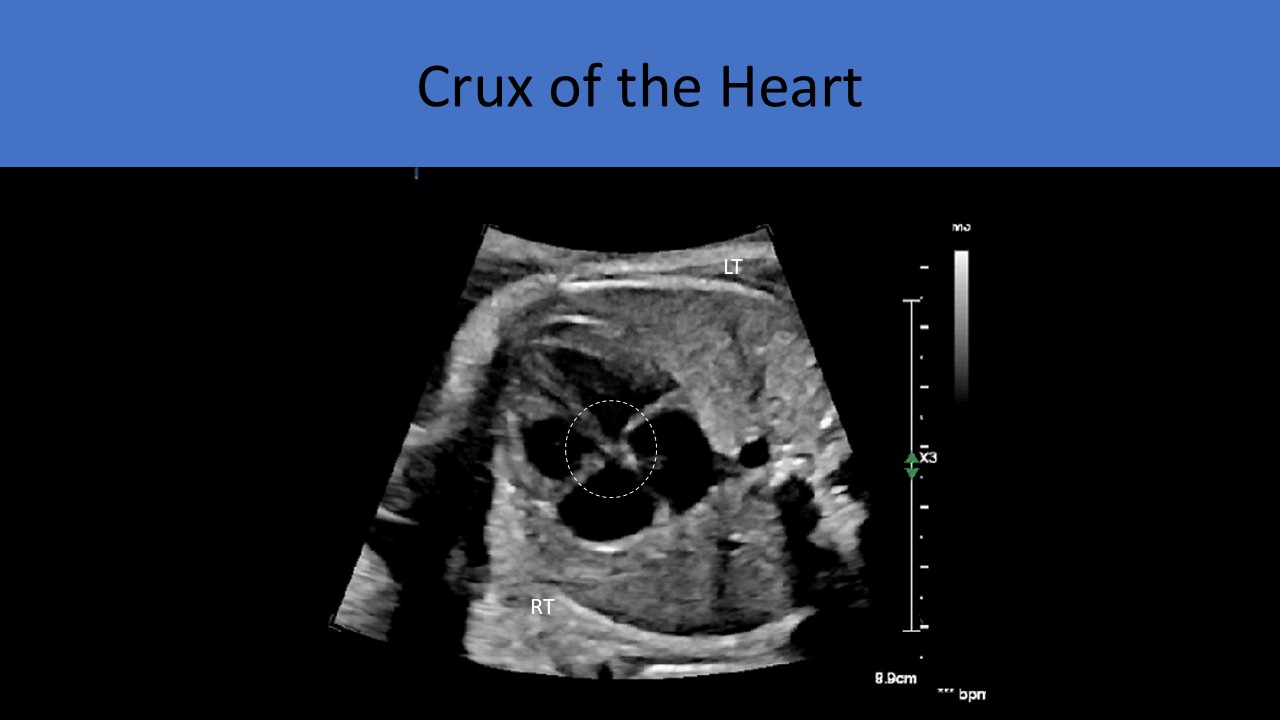 Fetal echocardiography image 1