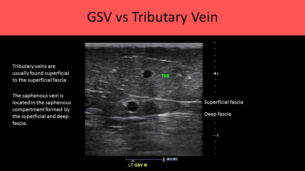 GSV vs Tributary vein
