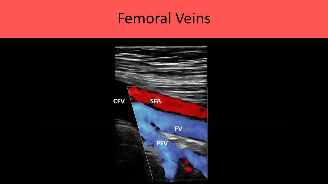 Femoral Veins