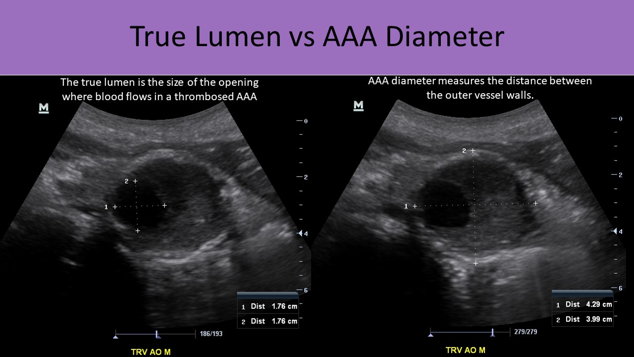 True lumen vs AAA diameter