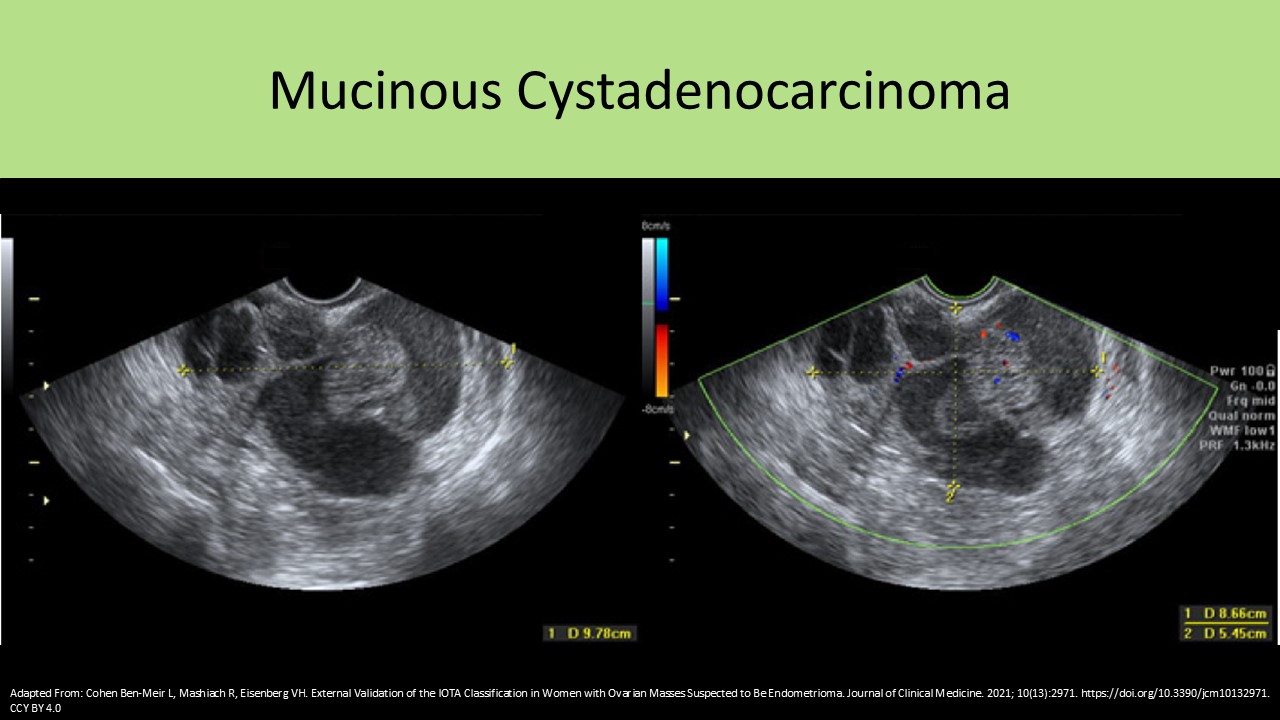 OB GYN ultrasound image 4