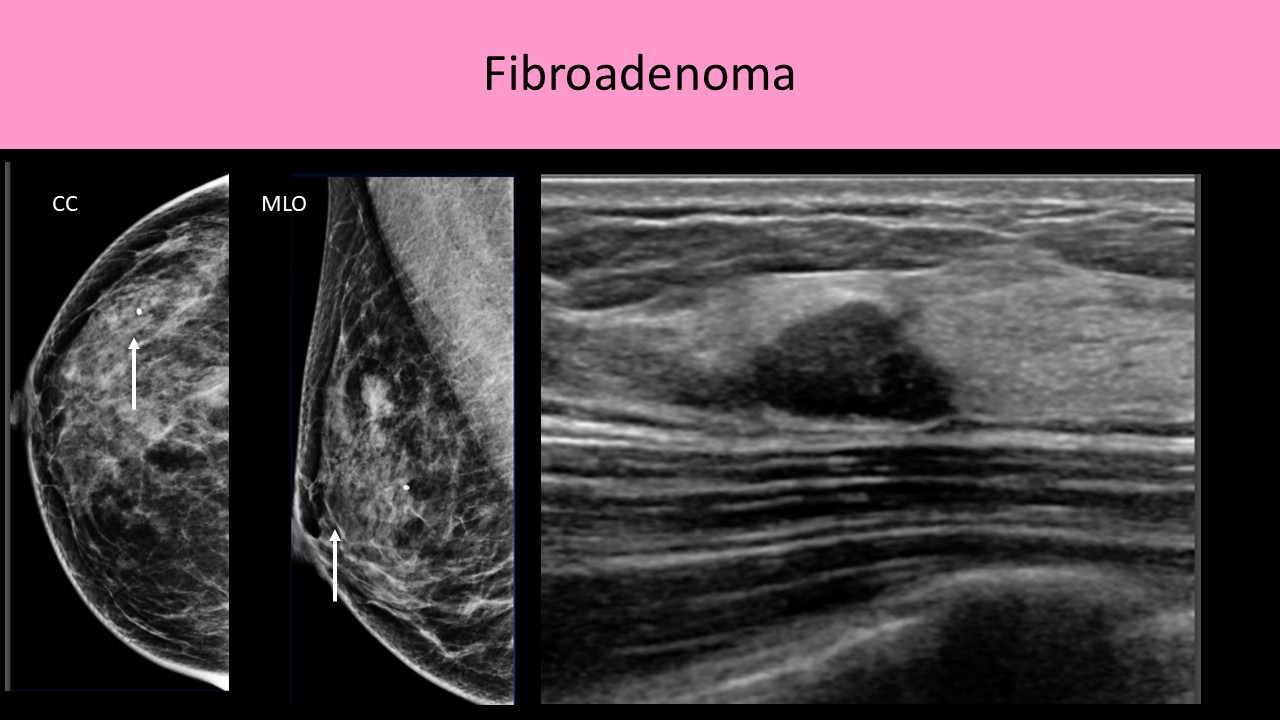 Breast sonography ultrasound image