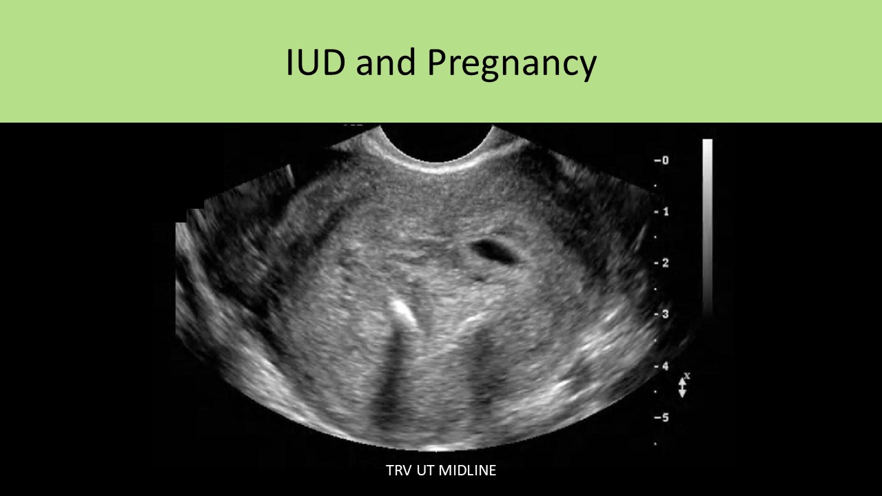 OB GYN ultrasound image 2